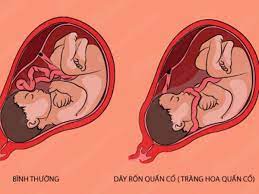 Dây rốn quấn cổ thai nhi