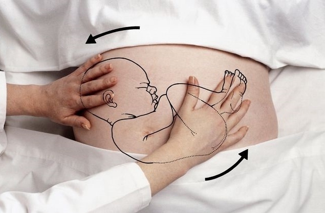 Phương pháp ngoại xoay thai