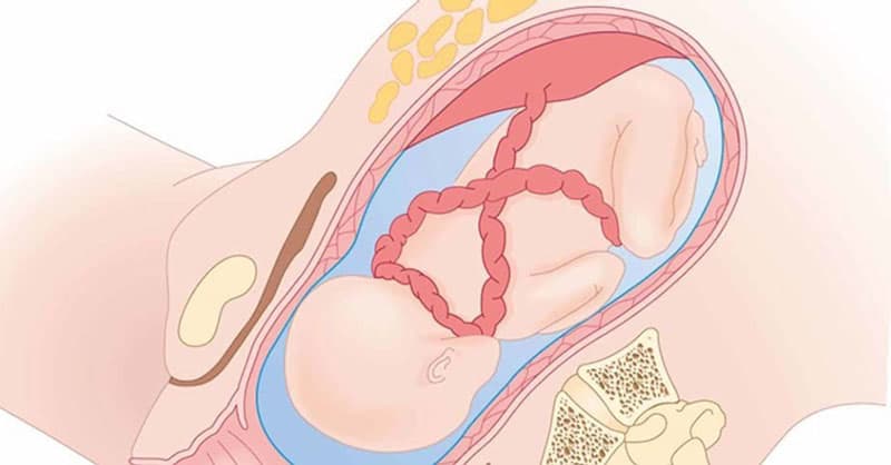 Hiện tượng dây rốn quấn cổ ở thai nhi
