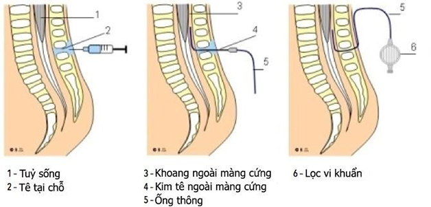 Phương pháp gây tê ngoài màng cứng