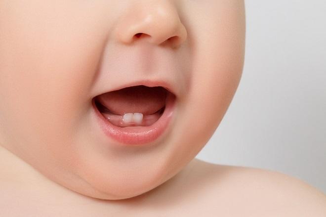 Tình trạng sâu răng ở trẻ 