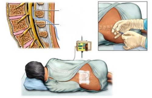 Gây tê ngoài màng cứng rất an toàn cho em bé trong bụng mẹ