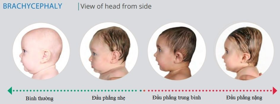 Giới thiệu về hội chứng đầu phẳng