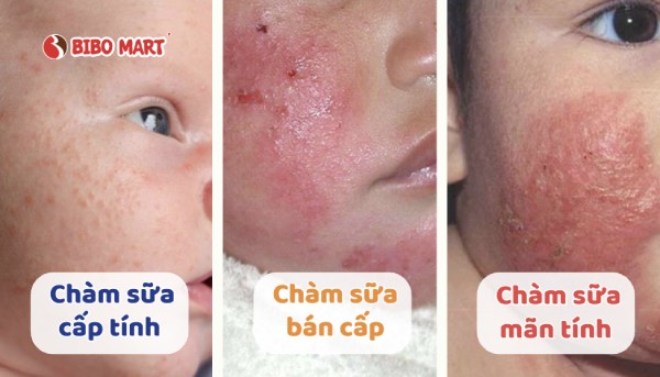 Các cấp độ chàm sữa sơ sinh