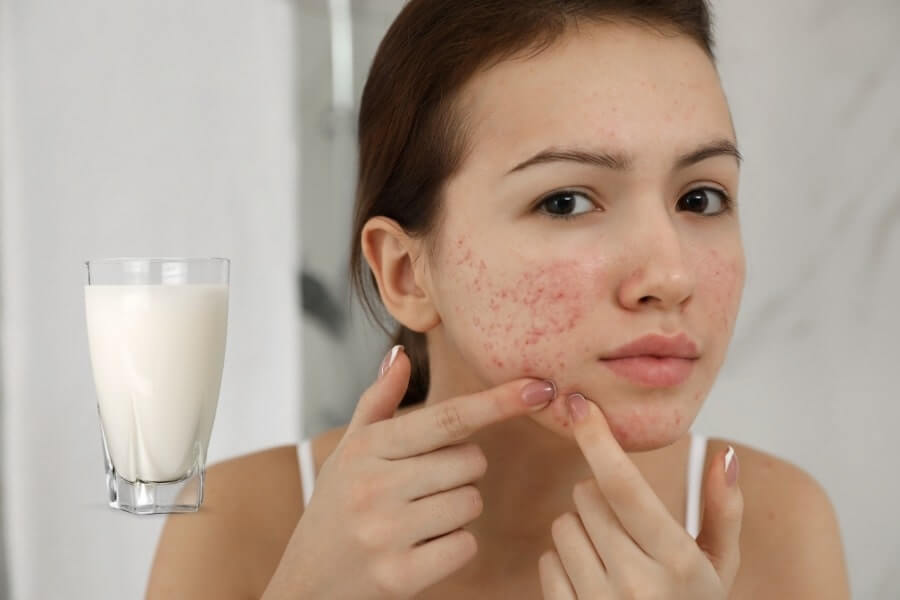 Không sử dụng sữa đặc khi bị mụn trứng cá