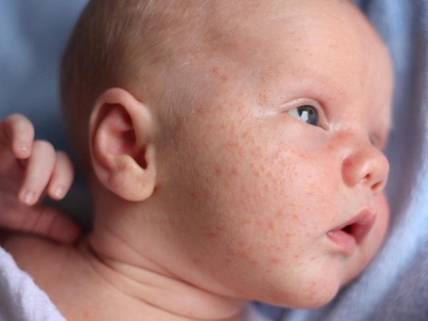 Phấn rôm giúp dịu nhẹ da khi kích ứng