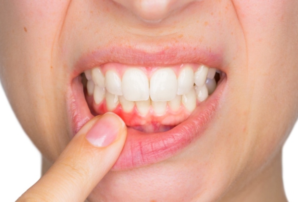 Những tổn thương trong khoang miệng có thể là nguyên nhân gây nhiệt miệng
