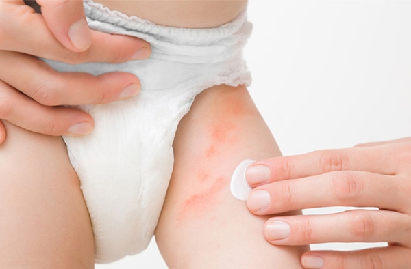 Mẹ nên thay bỉm thường xuyên cho bé để tránh bị hăm tã