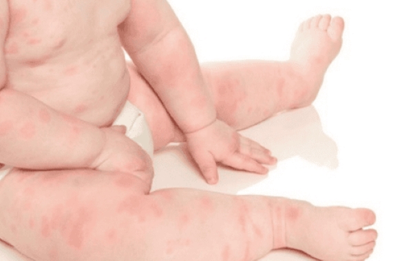 Triệu chứng phát ban, nổi mẩn ngứa mề đay do dị ứng với sữa