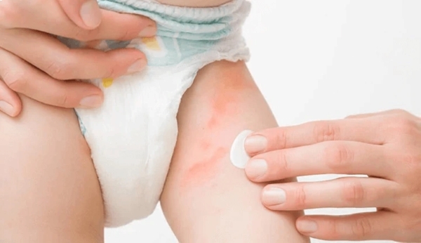 Dấu hiệu hăm tã thường gặp ở trẻ nhỏ