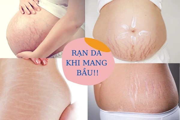 Tình trạng rạn da phổ biến ở mẹ bầu và sau sinh