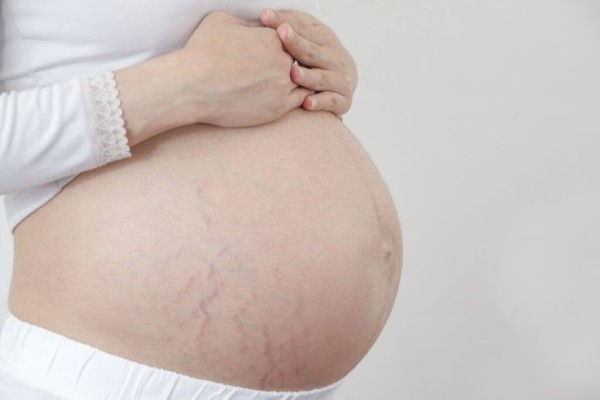 Mẹ bầu tăng cân nhanh dẫn đến tình trạng rạn da