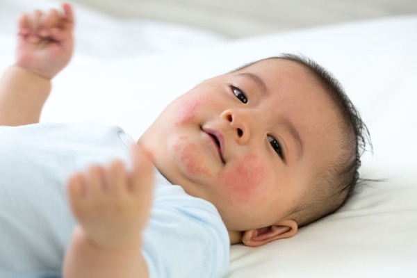 Dị ứng đạm sữa bò ở trẻ là gì?