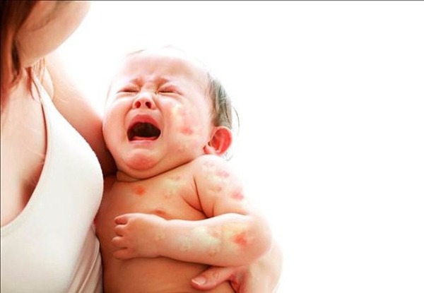 Nguyên nhân bé bị dị ứng đạm sữa bò