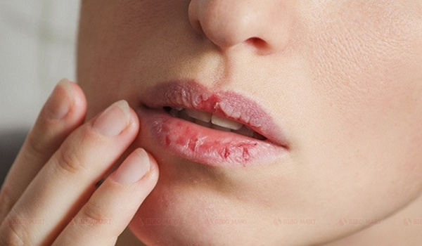 Môi khô do thời tiết lạnh và thiếu nước