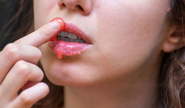 Giải đáp thắc mắc về cách trị môi khô